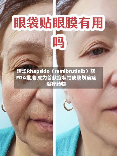 诺华Rhapsido（remibrutinib）获FDA批准 成为首款症状性皮肤划痕症治疗药物